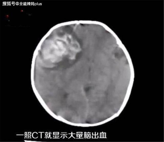 婴儿|2个月婴儿突发脑出血，只因宝妈一个饮食“陋习”，医生：抓紧改