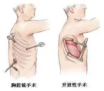 切胸手术图解图片