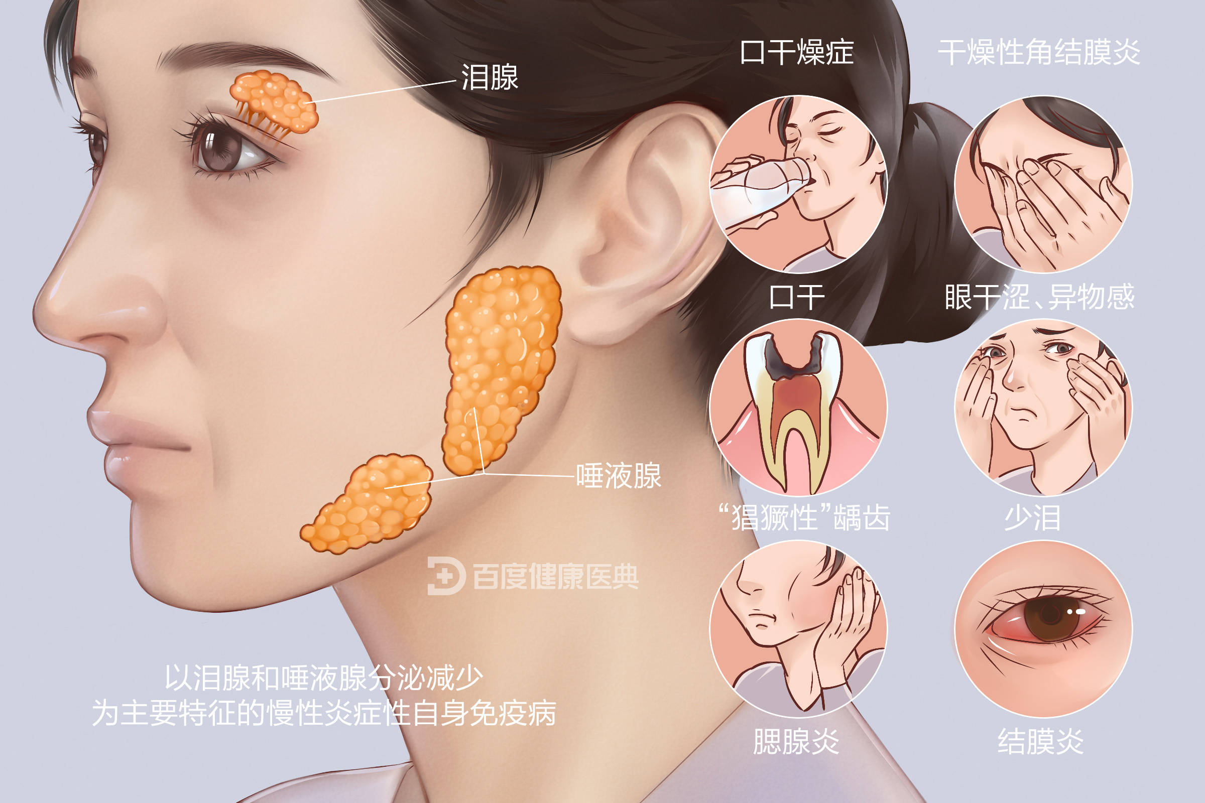 病毒|口腔黏膜专家陈友琼讲解：什么是干燥综合征？病因是什么？