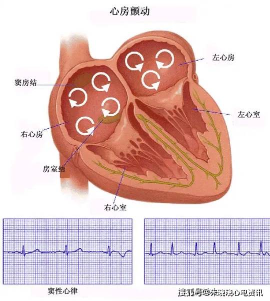 治疗|房颤患者注意!许多人最后导致中凤,就是因为有这些误区!一个都不能犯