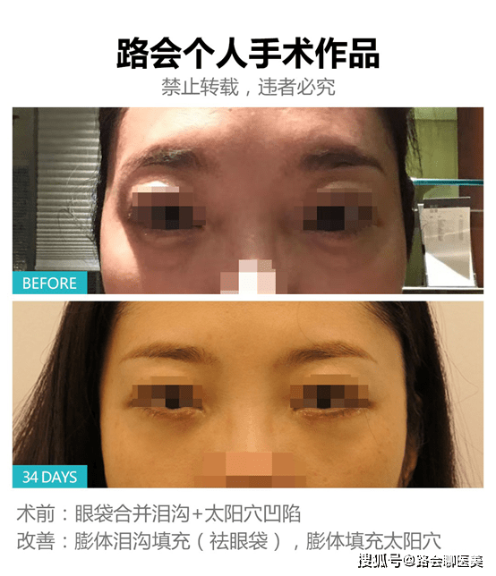 因为|面部凹陷填充可以选择假体吗？