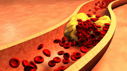 血管|大娘高血脂10年不上升，她是这样做的，坚持3个方法，血脂轻松