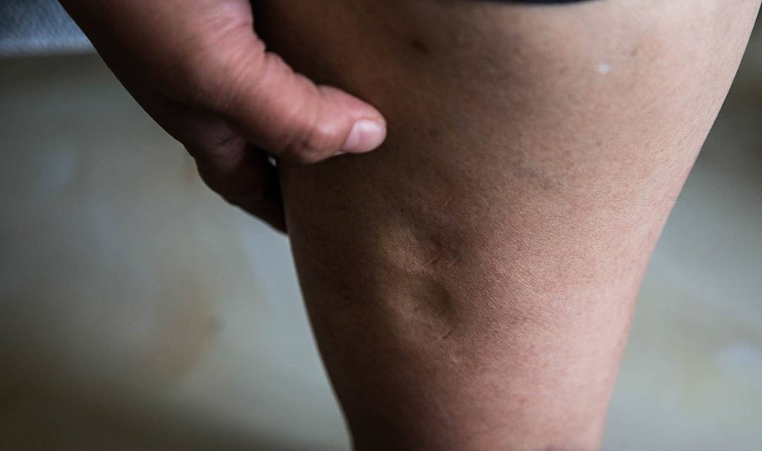 进行|血糖高的人，身体出现4异常，小心并发症！若没有，血糖还算稳定