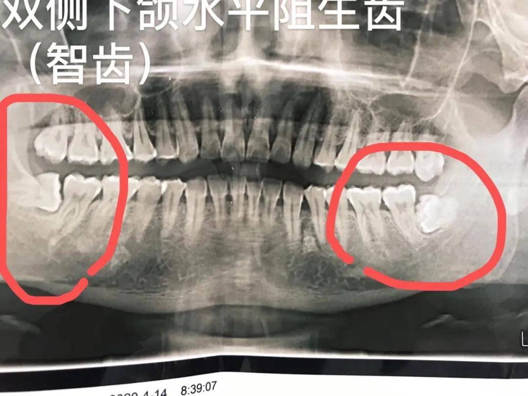 各類阻生牙(智齒),兒童埋伏牙,複雜牙等疑難牙齒的微創拔除.