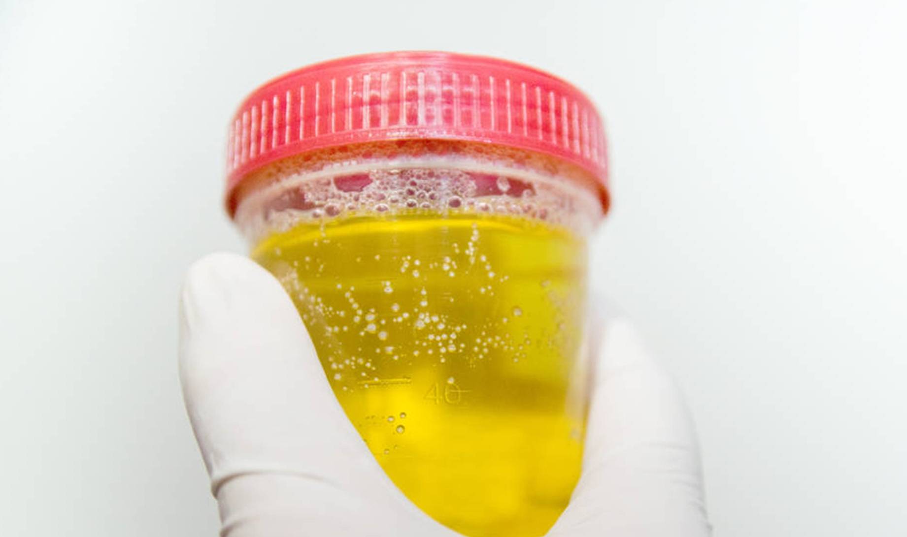 尿酸|高尿酸患者：身体若有4个异象，或是肾已被“伤透”，别再硬抗了