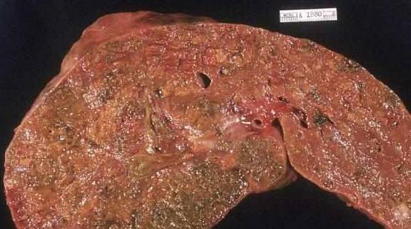 肝脏|肝硬化患者要注意的饮食注意事项，正确饮食可能会根治疾病