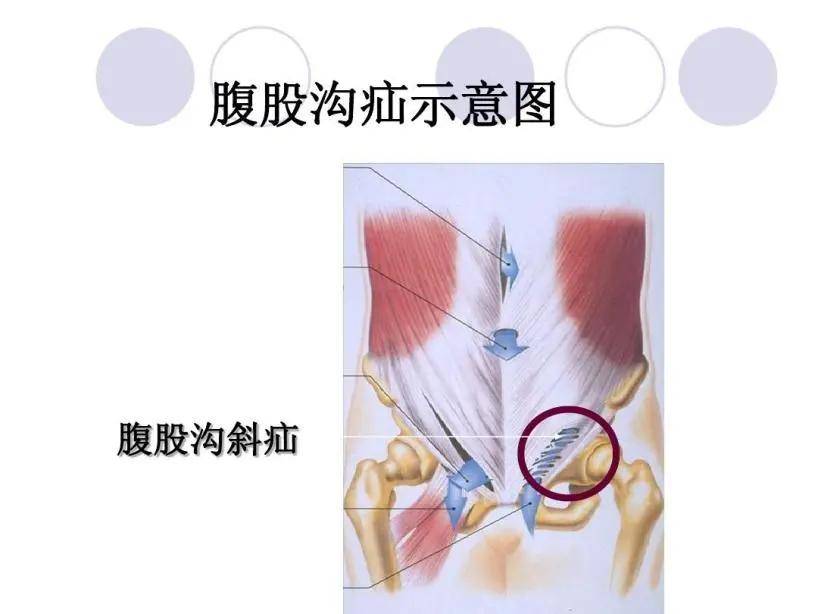 疝囊經過腹壁下動脈外側的腹股溝管深環(內環)突出,向內,向下,向前斜