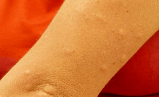 症状|渴、痒、麻？得了糖尿病之后，你 睡得好吗？