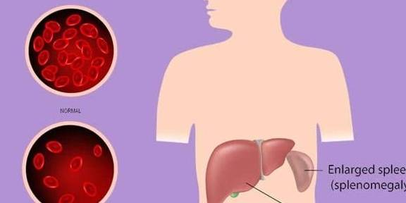 血液|体检出脾肿大,说明有肝硬化?慢性乙肝患者:欲知原因,请看此文