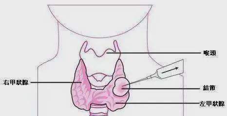 医学|揭秘甲状腺结节的良恶性：甲状腺细针穿刺