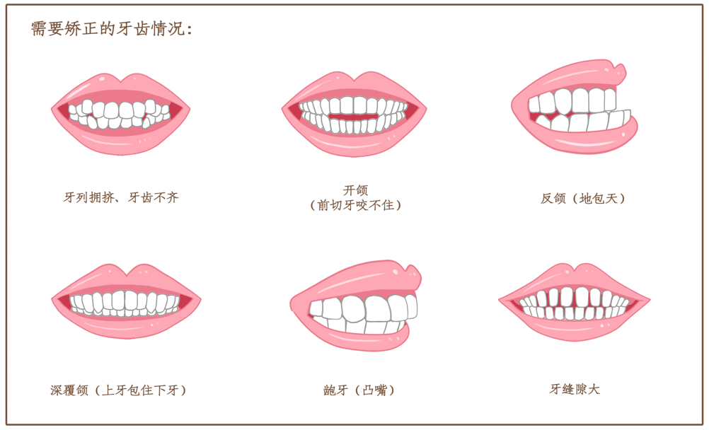 青少年|牙齿矫正知多少