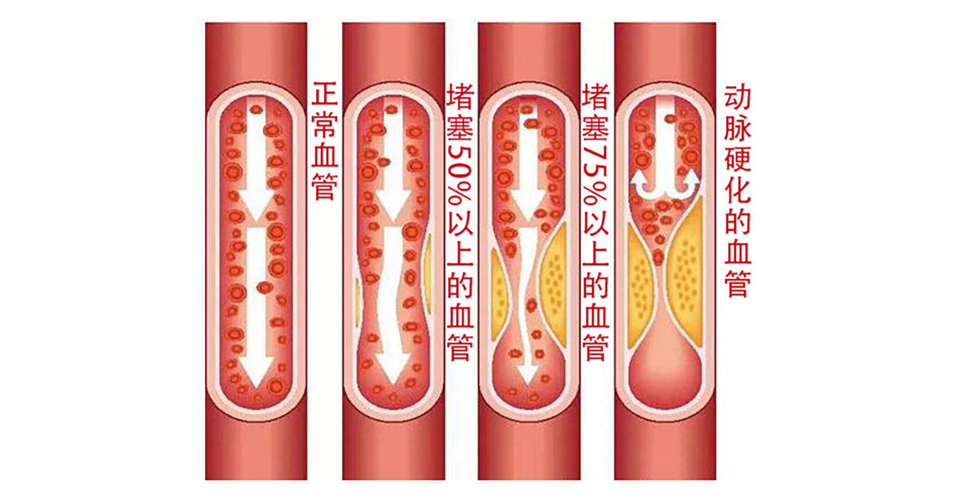 预防脑梗塞不用愁免烦脑预警头环监测脑血管脑梗塞发病预警