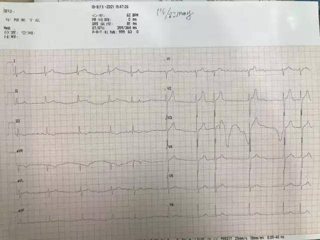 成功|山西省汾阳医院心内一科为一例持续性房颤患者成功实施房颤射频消融术