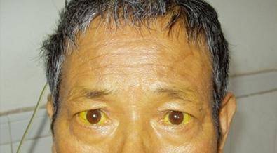 治疗|乙肝脸上会出现3种症状,中医用“土方子”,让你跟乙肝说拜拜