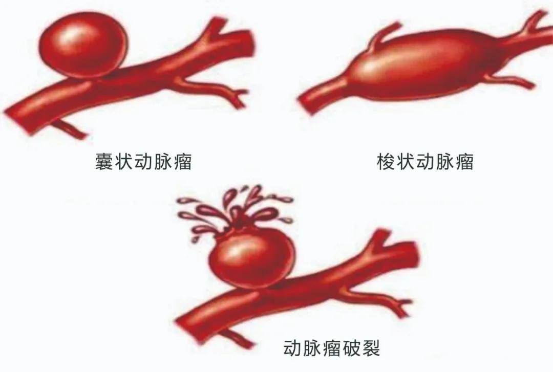 动脉瘤虽然名字里有个"瘤"字,但此瘤非彼瘤,它是脑血管壁异常膨出的"