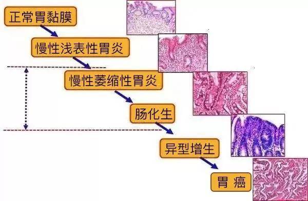识别|对照看你是胃癌高危人群么？如何识别胃癌早期信号?