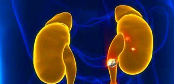 治疗|肾结石，真的可以自己排出来吗？你或许真的不知道，看专家的理解