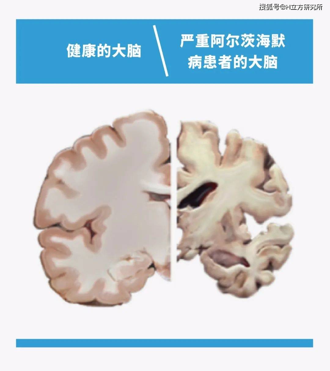 障碍|有关阿尔茨海默病，你需要知道的7件事
