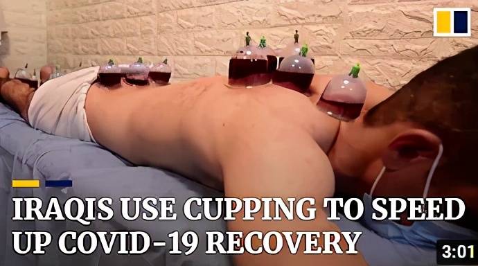 文化|这届老外，终于知道拔罐的秘密了？