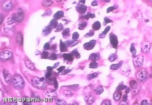 的。细菌性阴道炎一般属于杂菌感染，引起白带增多，颜色或气味异常等。