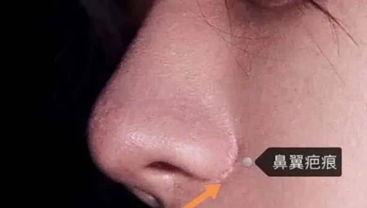 张力|五官C位可不能随便动,鼻综合也不是人人适合!