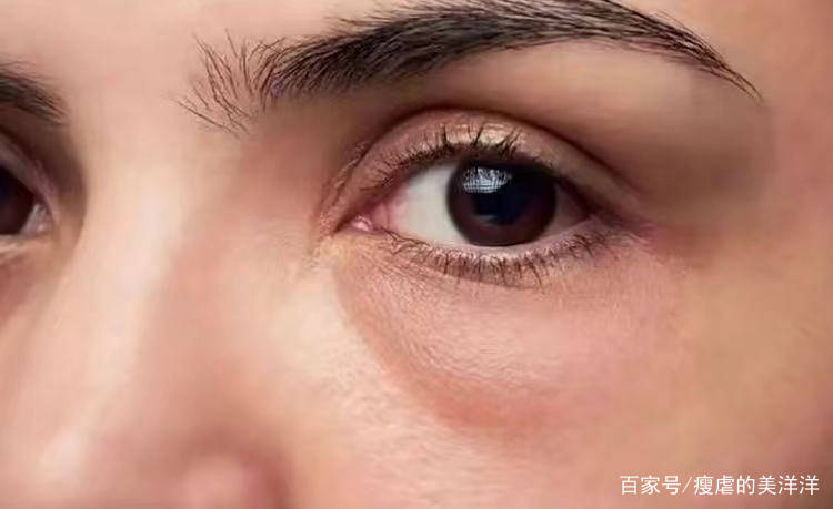 眼睛|有眼袋，20岁的小仙女也会被拖累成老阿姨！