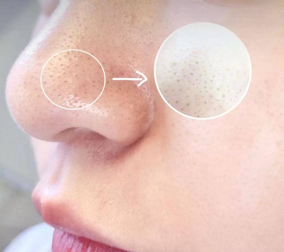 小气泡一招ko顽固黑头 解决肌肤问题