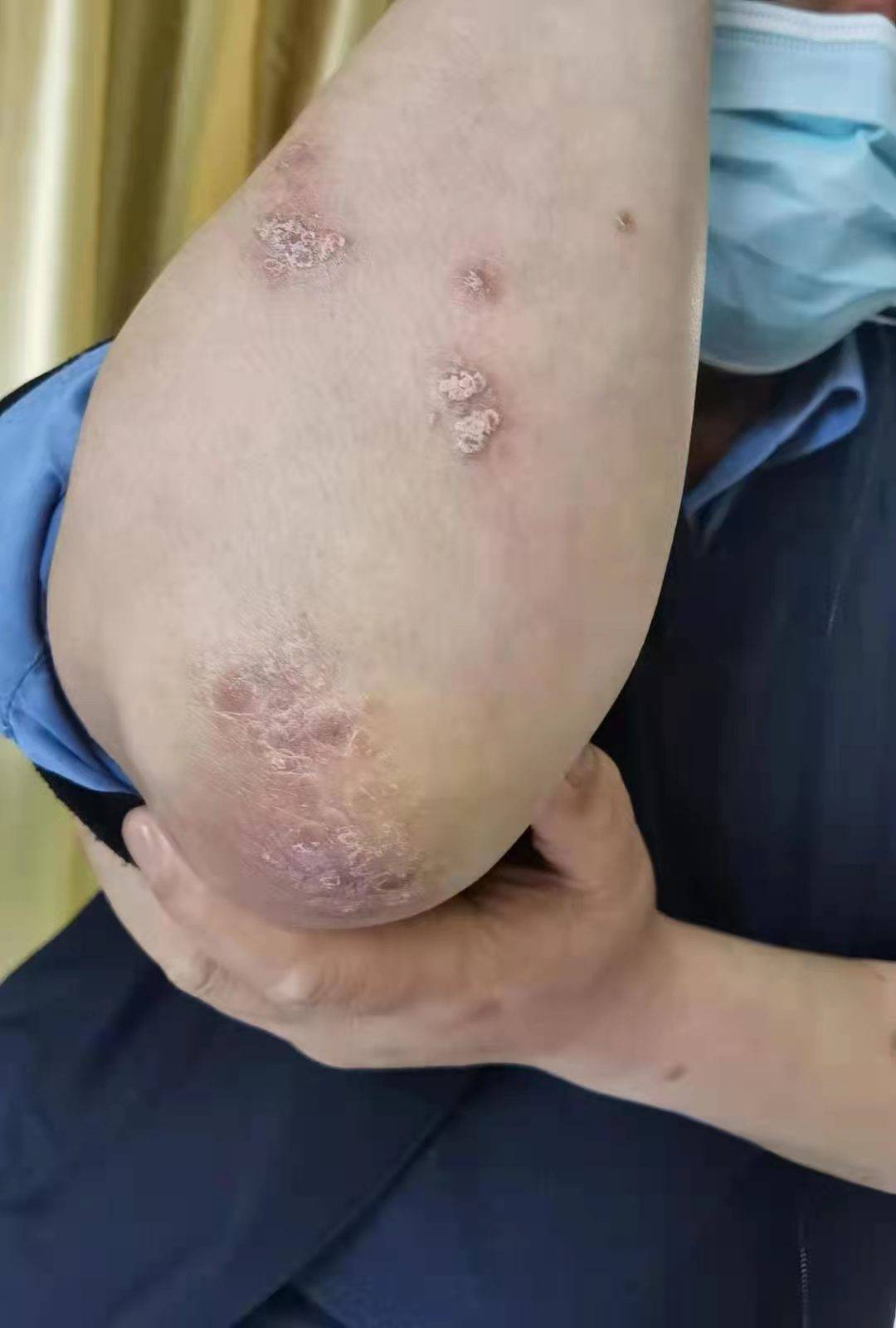 《崔永喜医案选》——牛皮癣(银屑病)案_皮损