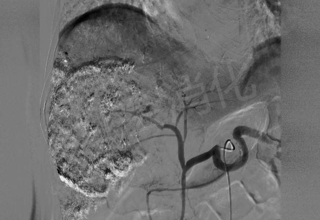血管|西安市红会医院 让肿瘤“饿”死的TACE术 为两例中晚期肝癌排忧