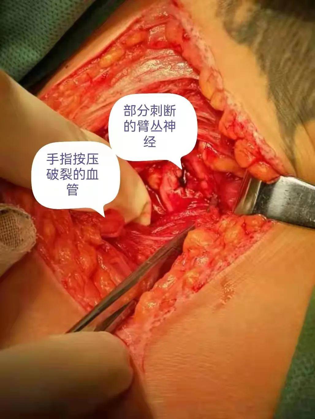 锁骨|意外刺断重要神经血管 ▏市三院急诊创伤中心联手全力抢救成功