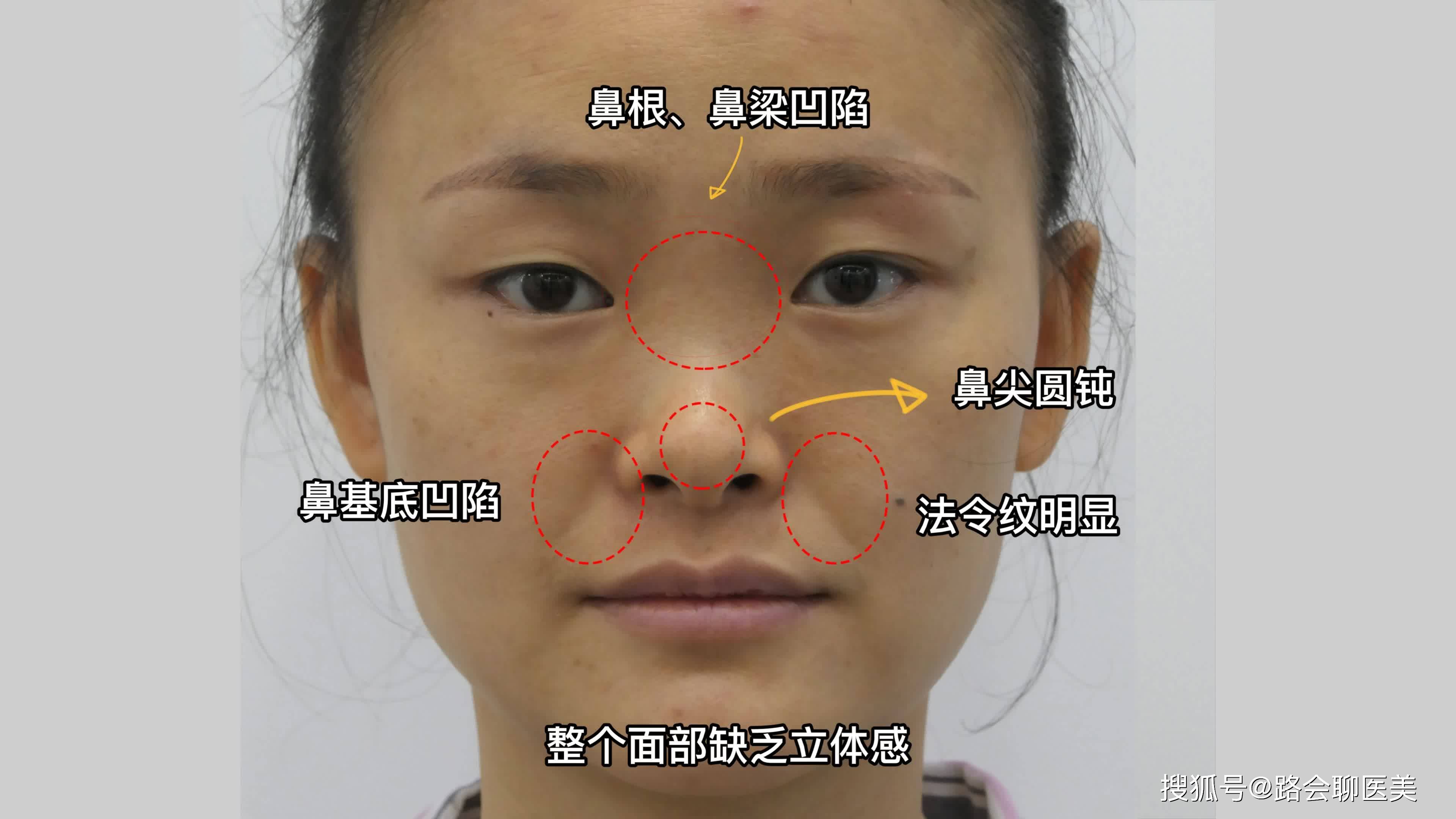 鼻根低矮鼻梁塌陷鼻基底凹陷看她两个月的变化