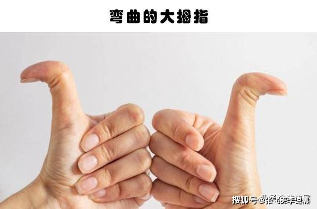 罕见的身体特征:只有少数人身上才拥有的10个罕见的特征_大拇指