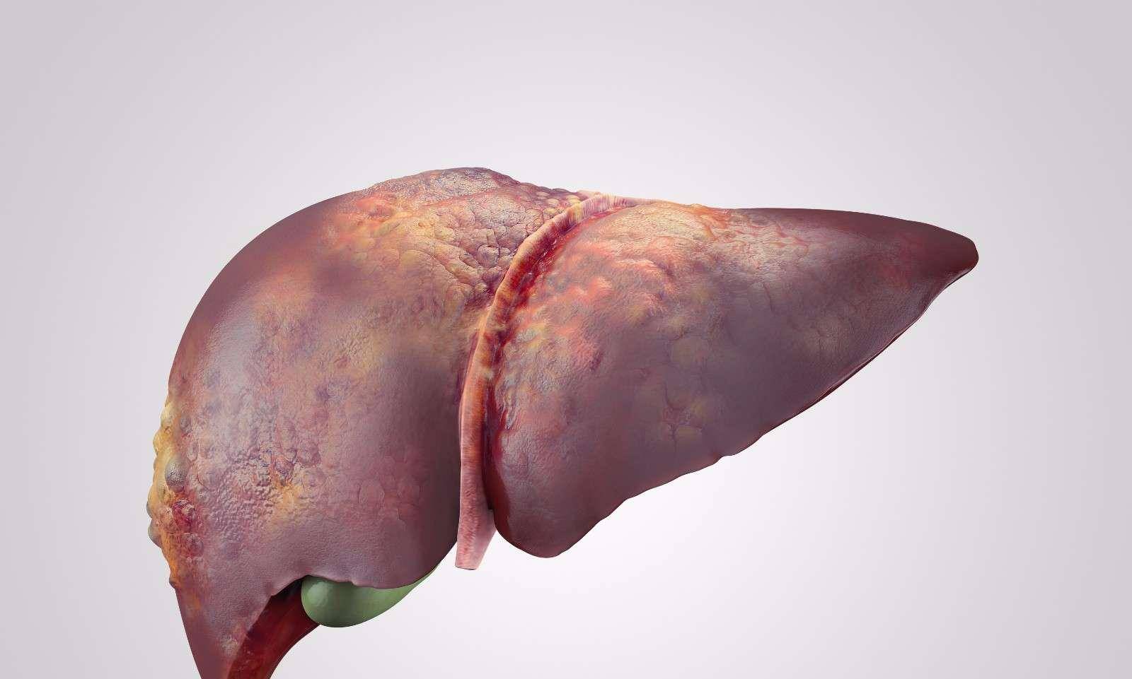 症状|一查就是肝硬化？肝病医生提醒：2个原因勿放过