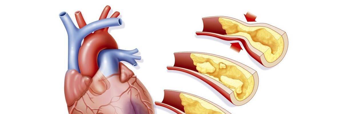 造影|45岁女性急性心梗，开始医生也有所怀疑，最后找到了原因
