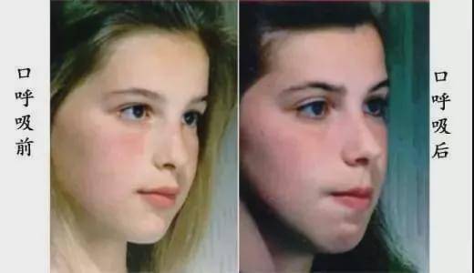 变形|新依美瘦脸:这些坏习惯会让你的脸越来越大