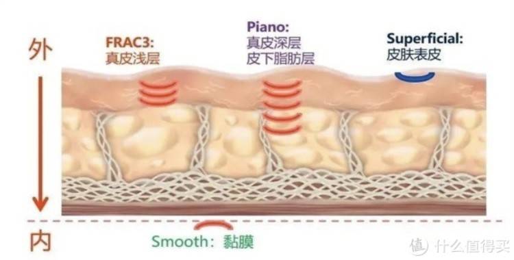 玛吉|fotona 4d和热玛吉区别？都有什么好处和坏处