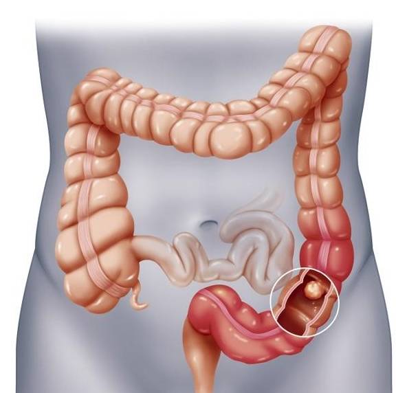 类人|4类人易被直肠疾病“盯上”,快看你有没有在其中