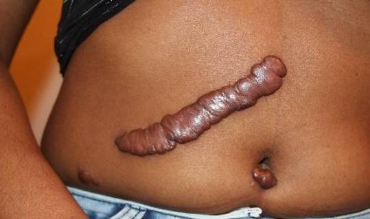 症状|半年就要命，吴邪得的肺纤维化是什么病？