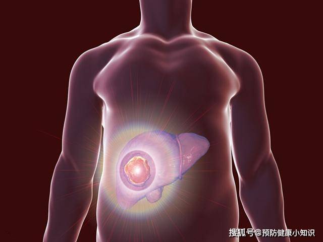 症状|46岁老李肝功能正常，却突然查出肝癌晚期？原来皮肤早有提醒