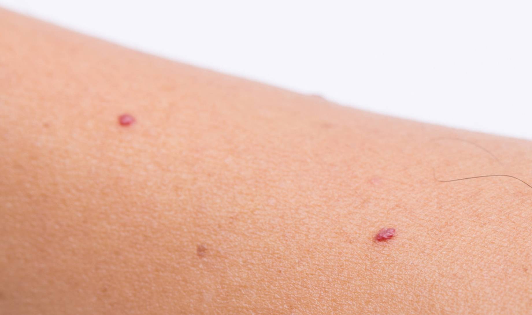 饮食|误以为皮肤过敏，却查出肝硬化，提醒：皮肤1处异常多是肝脏病变