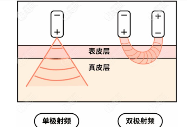 玛吉|到底是选择面部btl和热玛吉哪个好？我是纠结过的~