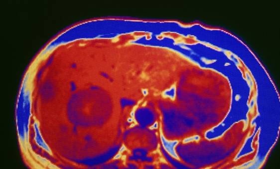 症状|肝硬化越来越多!医生:肝硬化到肝癌,身体会给3次机会,要珍惜