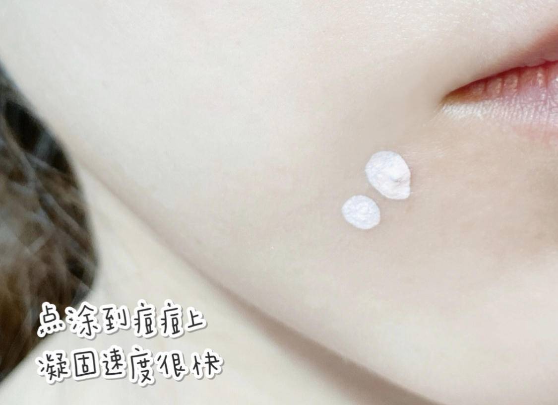 因为|对付痘痘就得少而精！