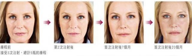 脸部|全脸脂肪填充安全吗？脸部脂肪填充有风险吗？