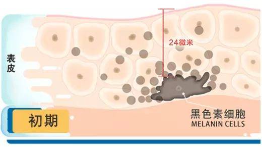 治疗|如何祛除烦人的黄褐斑？