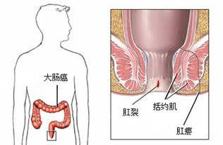 得了肛瘘该怎么办呢