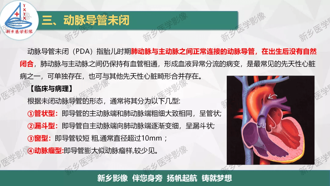 【一圖明白】房缺,室缺,動脈導管未閉如何分型?