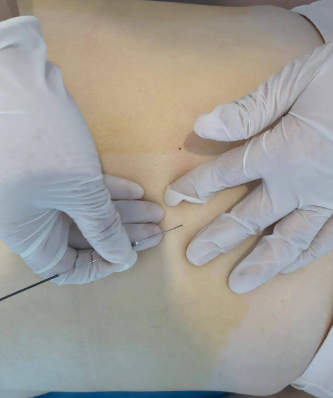 功能|穴位埋线不是减肥的“专利”