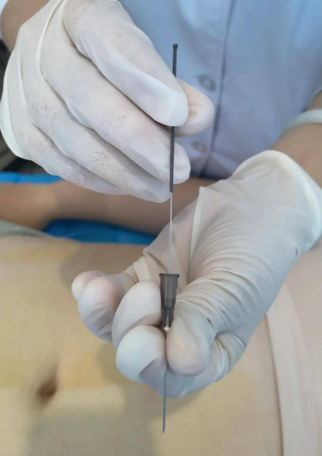 功能|穴位埋线不是减肥的“专利”