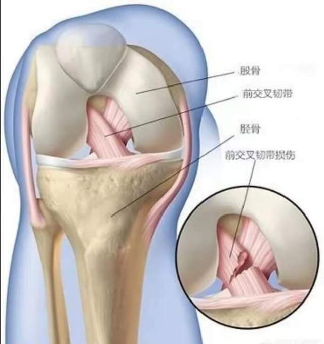 能走能跳为什么要开刀 2厘米韧带撕裂诱发大麻烦 膝关节